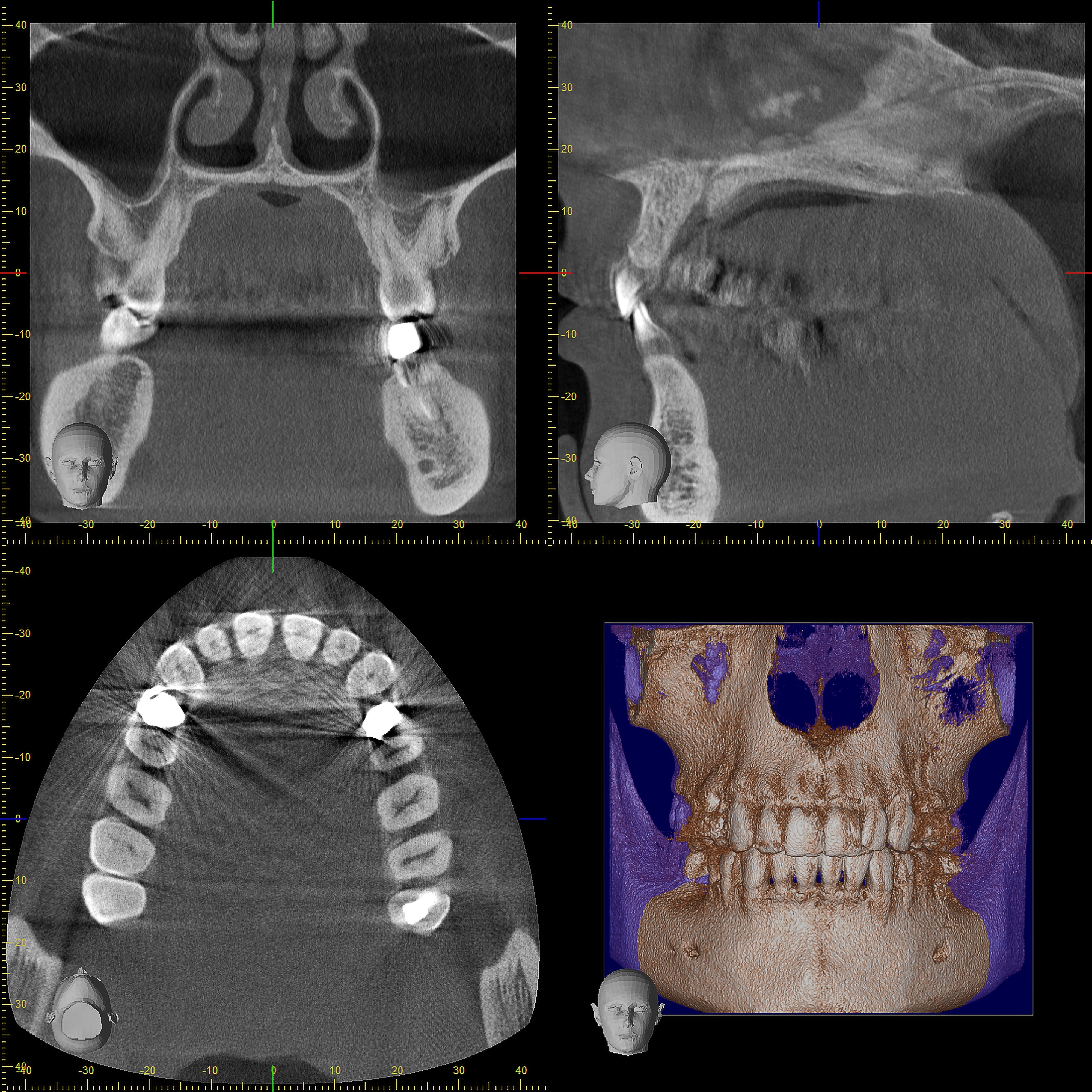CBCT-scanning til planlægning af All-on-4/6